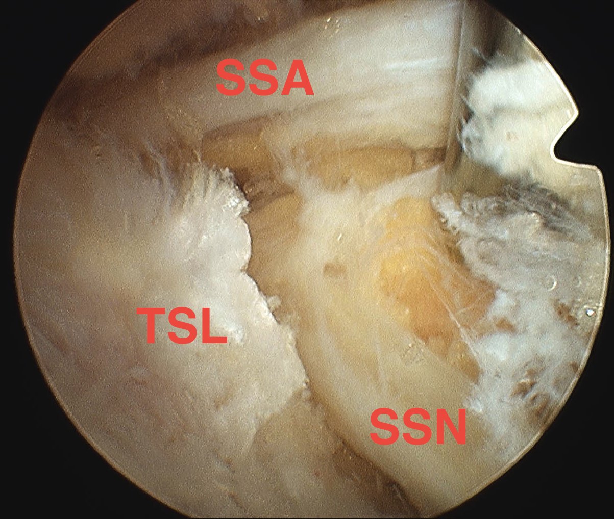 SSN Release Divided TSL